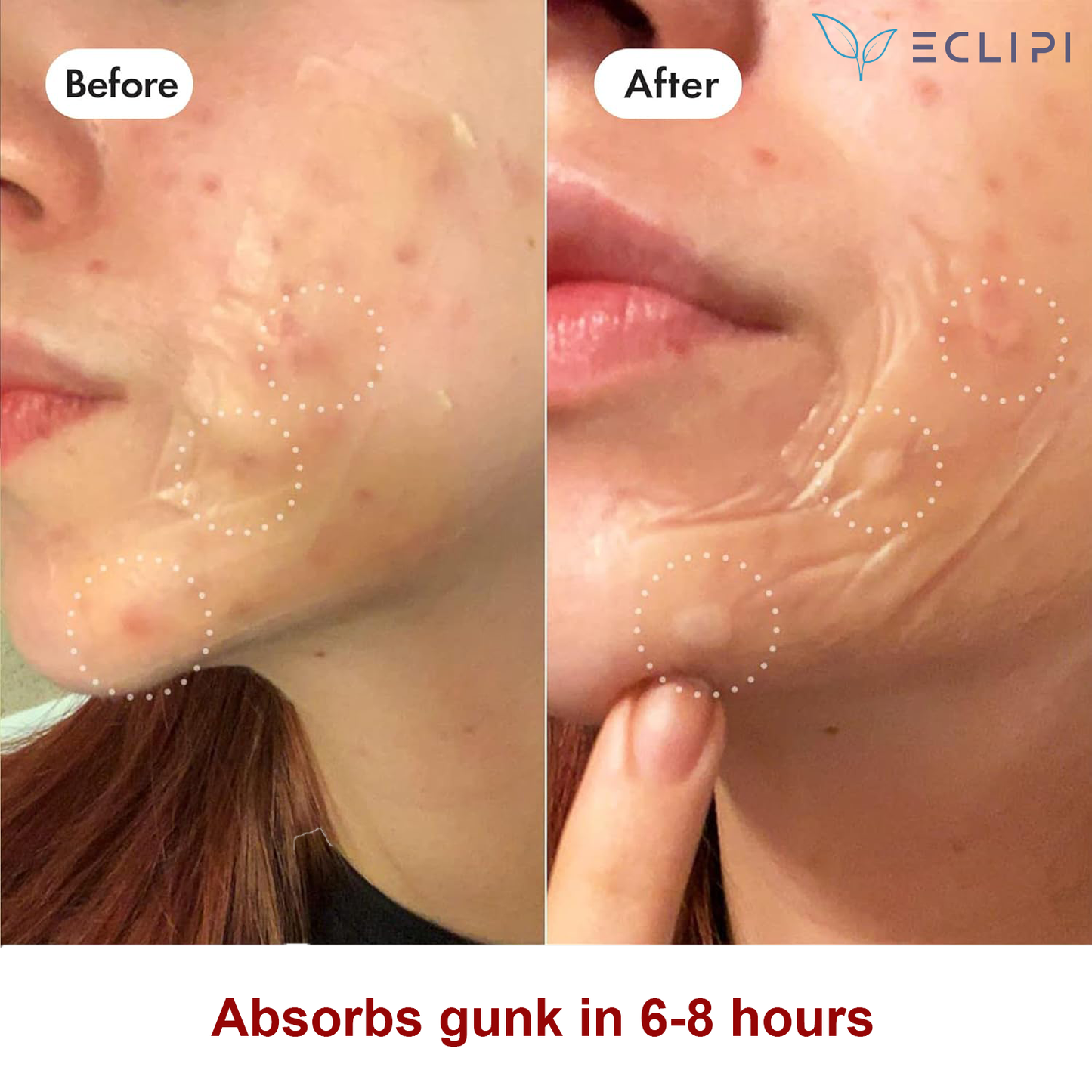 Eclipi Surface Large Pimple Patches 10 PCs – XL Hydrocolloid Strips for Face & Body Acne, Covers Breakout Clusters on Cheeks, Forehead, Chin & Jawline, Easy Peel Pimple Stickers